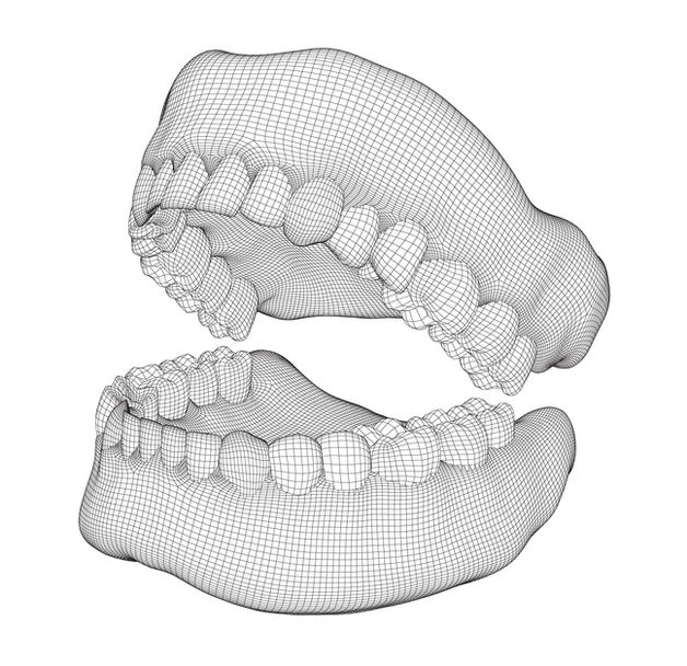 3D tooth movement simulation